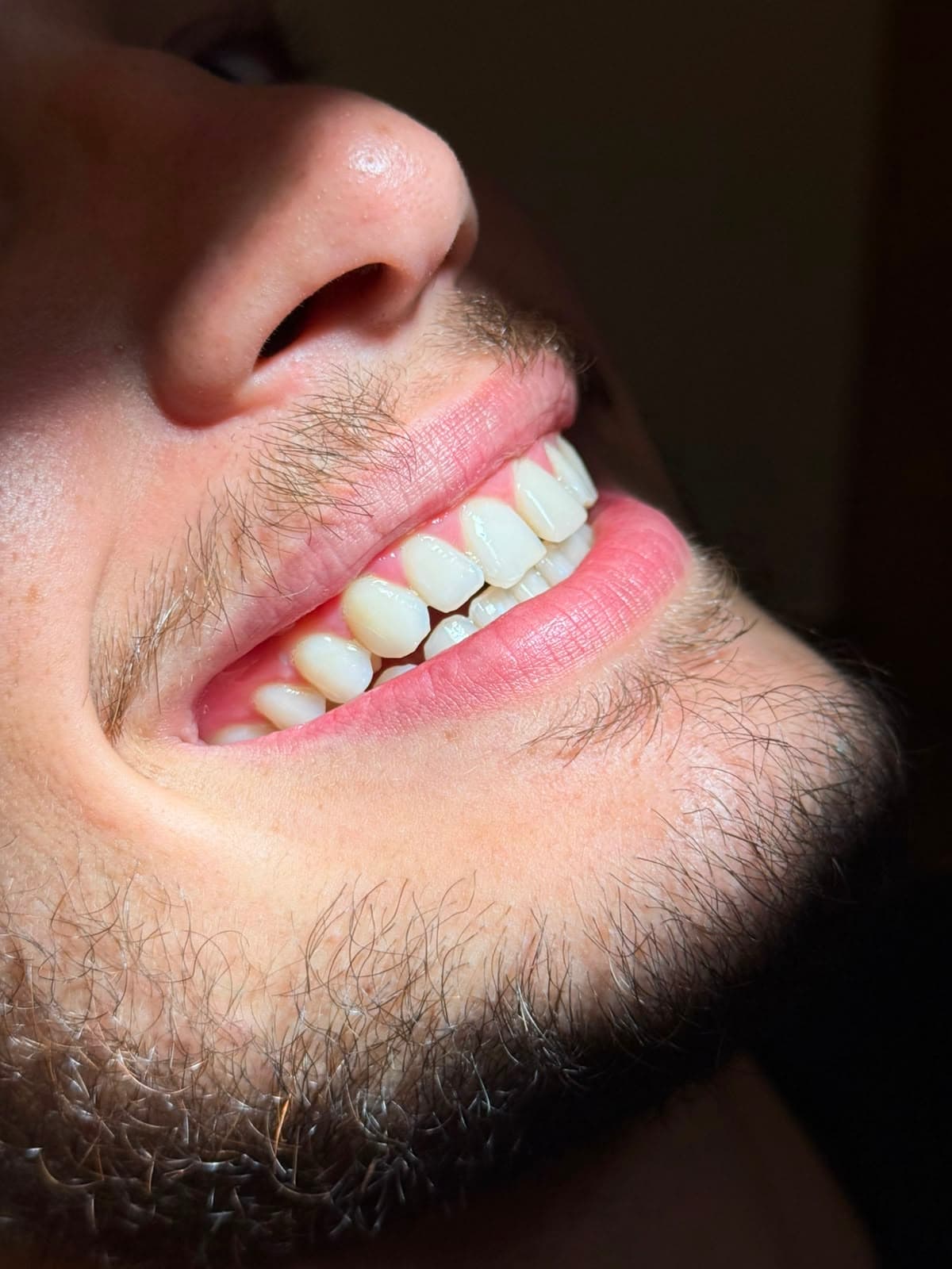 Sorriso após o clareamento dental na Clínica Cler, com resultado natural